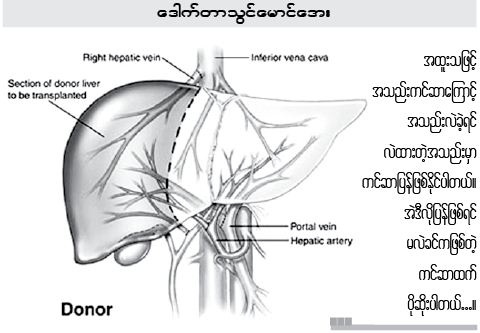 အသည္းအစားထိုး ကုသျခင္း (Liver Transplantation) အပိုင္း (၁)
