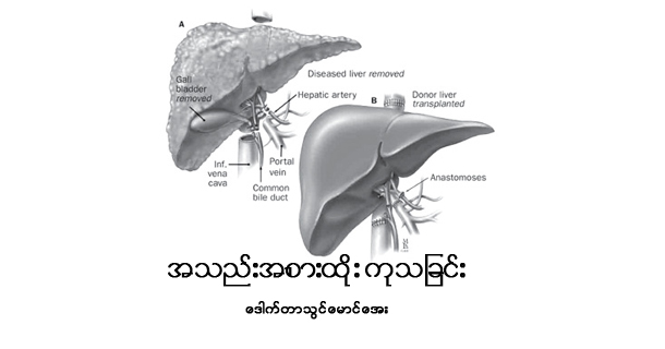 အသည္းအစားထိုး ကုသျခင္း  (Liver Transplantation) အပိုင္း (၃)